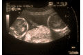 Echographie g�mellaire